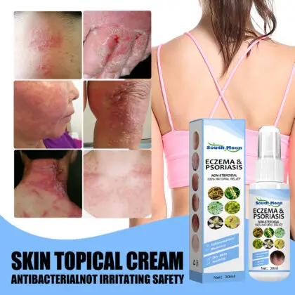 Skin infection Treatment Spray for Ringworm, Eczema & Psoriasis
